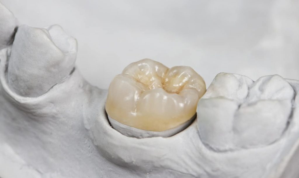 Dental crown on tooth casting