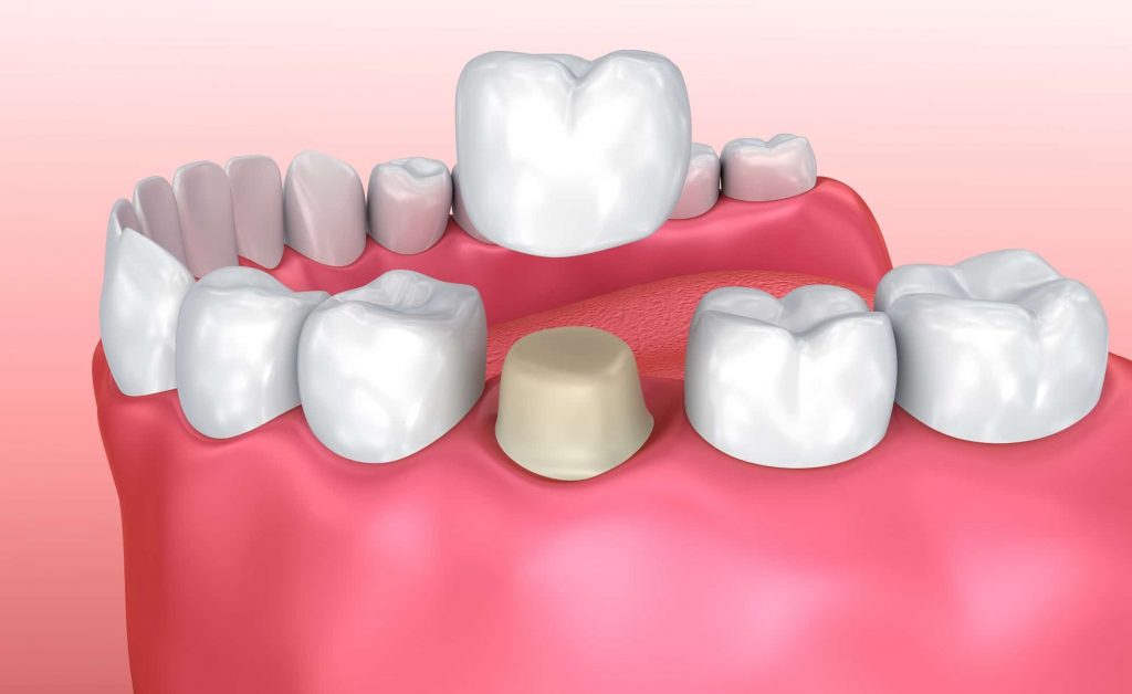 Dental crown installation