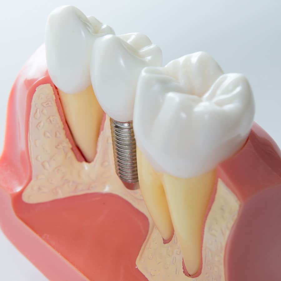 Dental implant