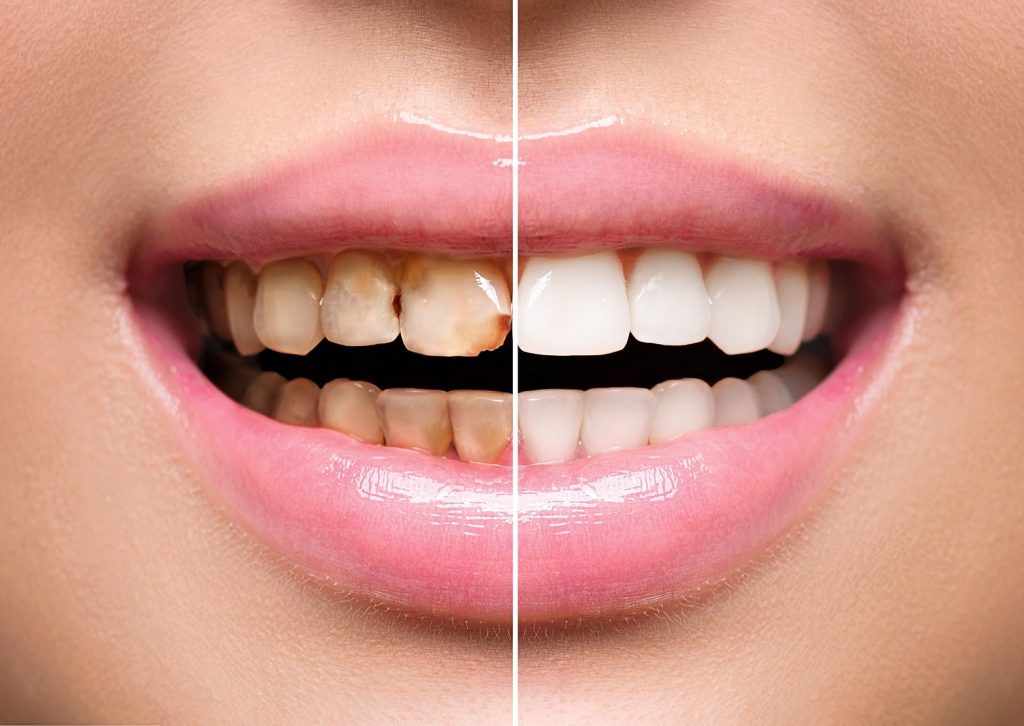 Woman's teeth before and after dental restoration