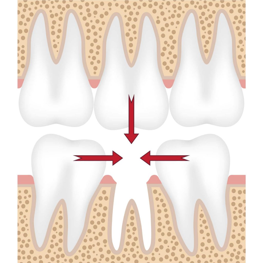 Bowie MD Extraction Site Preservation with Bone Graft