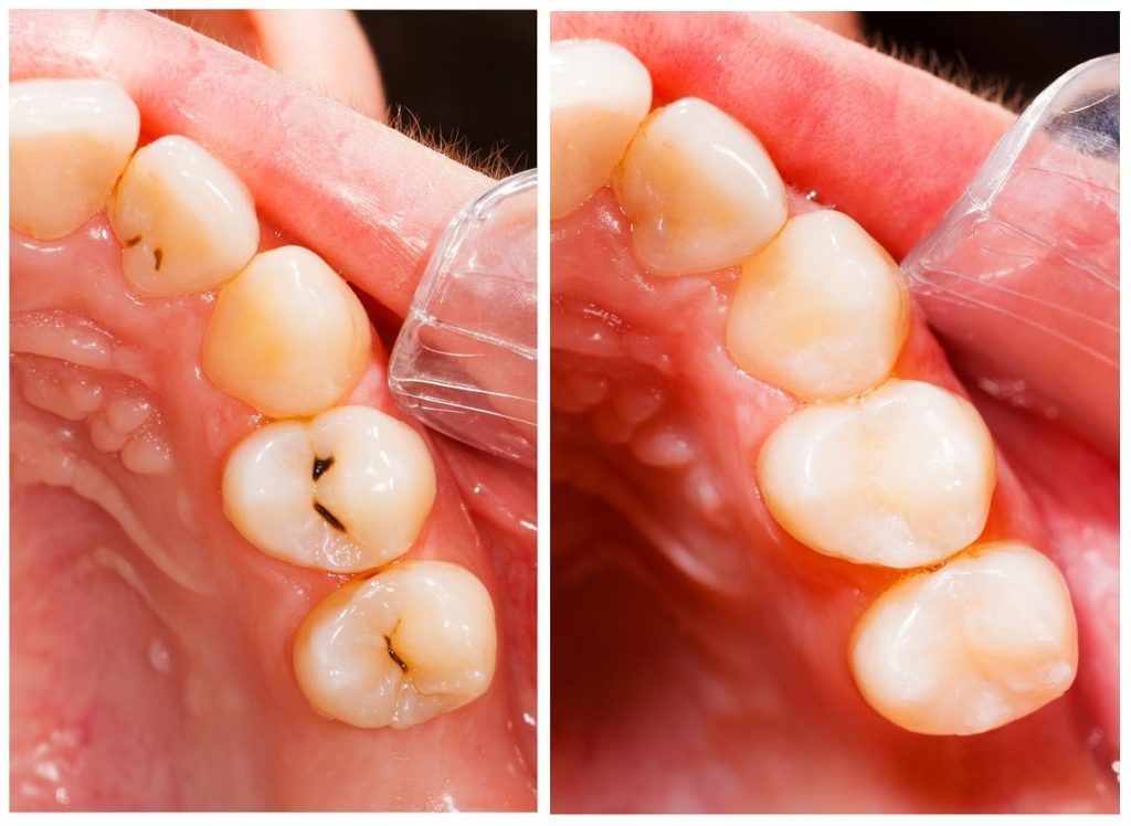 Before and after dental filling
