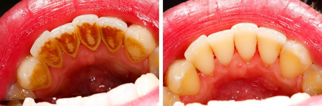 Teeth before and after ultrasonic dental cleaning