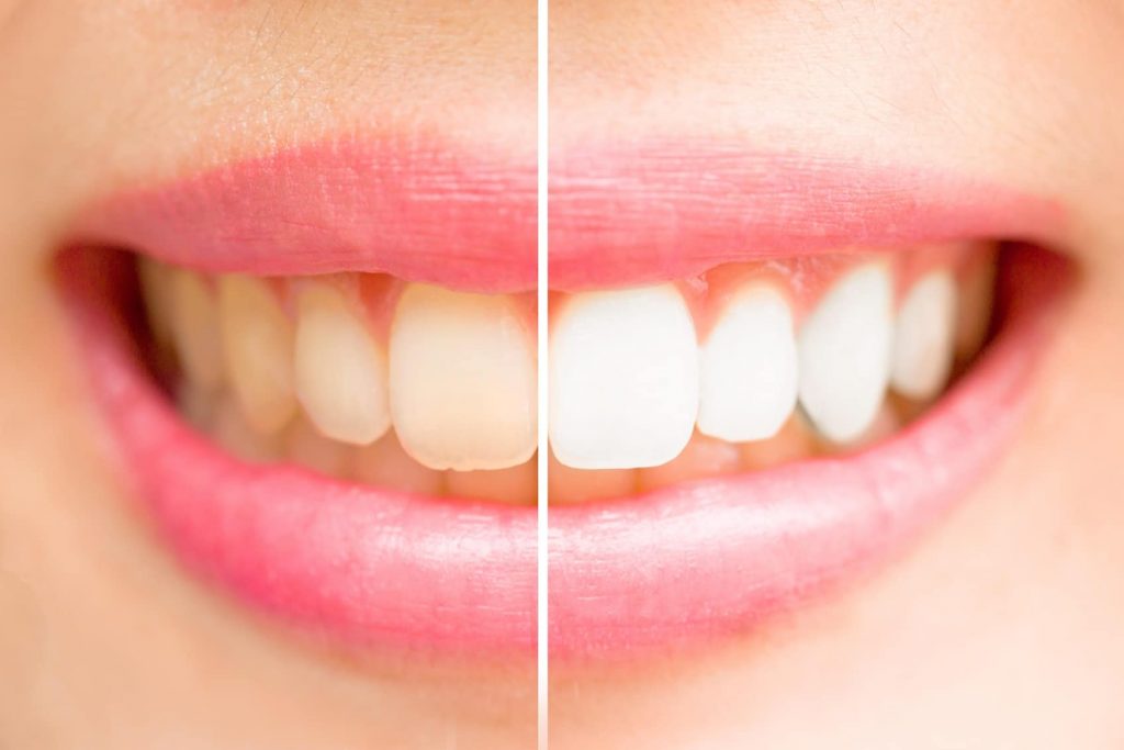 Teeth before and after whitening